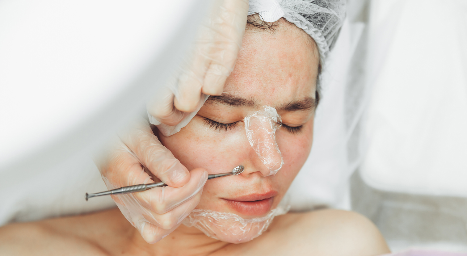 Acne Facial